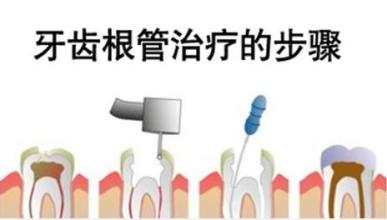 牙痛需要做根管治疗吗？