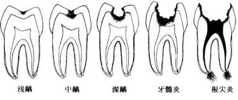 龋齿不痛还需要治疗吗？