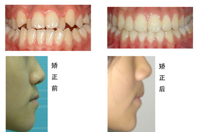 矫牙期间出现疼痛怎么办？