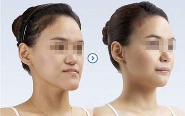 地包天什么时候矫正比较好？