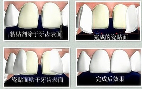 瓷贴面的效果怎么样？