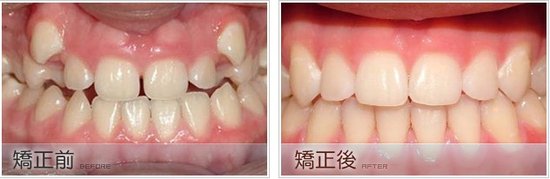 拔牙矫正危害身体健康吗？