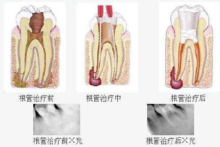 什么情况下需要做根管治疗？