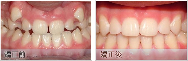 做牙齿矫正有年龄限制吗？