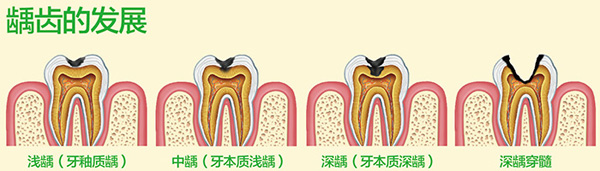 深度龋齿怎么治疗？