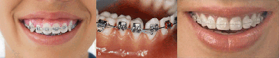 牙周炎患者能做牙齿矫正吗？