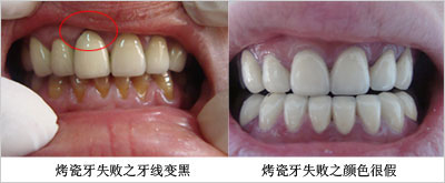 烤瓷牙失败有哪些危害？