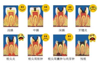 龋齿会传染吗？