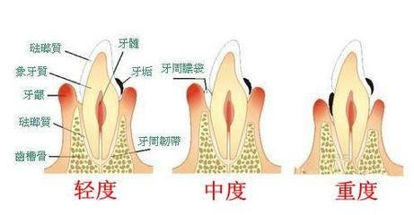 如何判断自己是否患有牙周炎？