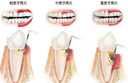 哪些方法可以预防牙周炎？