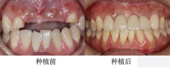 前牙种植需要多少钱呢？
