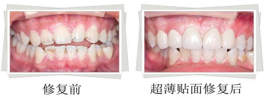 用瓷贴面修复门牙好不好？