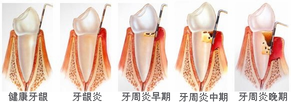 哪些人群易高发牙周病？
