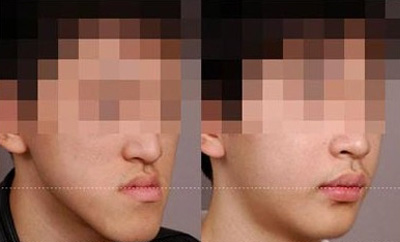 青少年多少岁适合矫正牙齿？