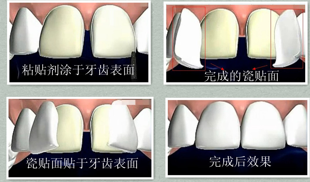 瓷贴面是怎样进行修复的？