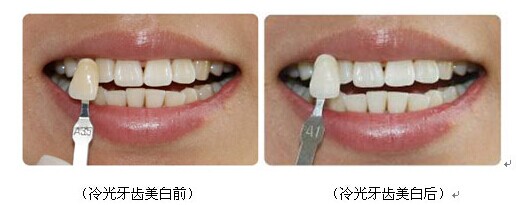 牙齿做冷光美白安全吗？