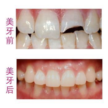 深圳牙齿缺损补牙多少钱？