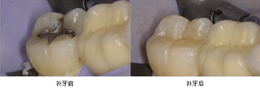 蛀牙疼痛时能补牙吗？