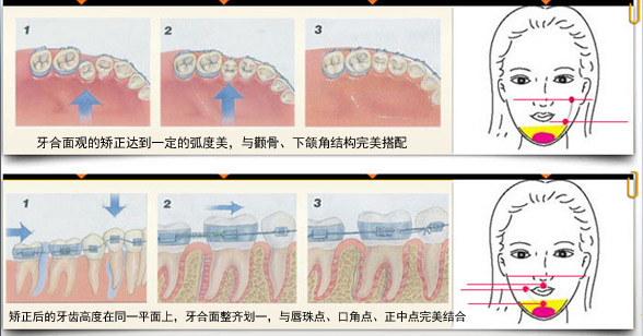 牙齿矫正的原理是什么？