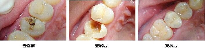 孩子乳牙龋齿需要拔掉吗？