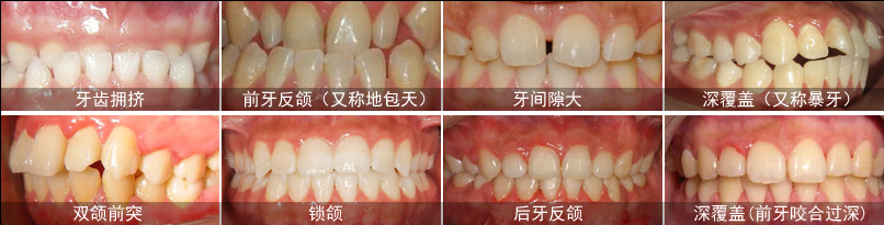 哪些患者适合做隐形牙齿矫正？