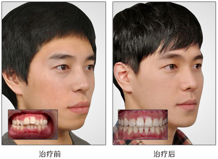 成年人龅牙怎么矫正比较好？
