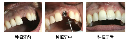 如何提高种植牙使用寿命？