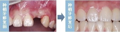 为什么做种植牙还需要植骨？