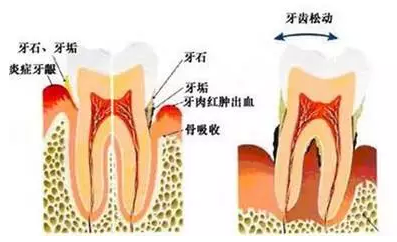 牙齿松动可以洗牙吗？
