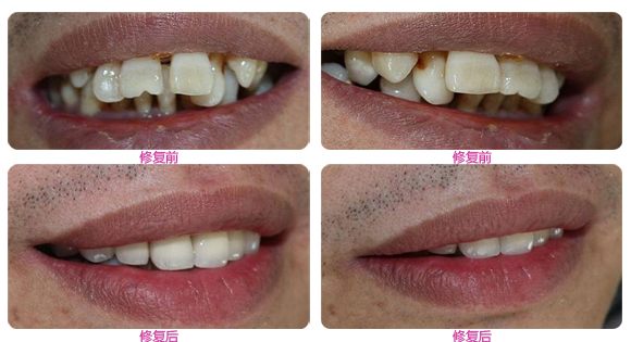 龅牙可以做烤瓷牙修复吗？