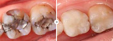 蛀牙不疼还需要治疗吗？