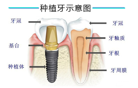 种植牙的材料主要有哪些？