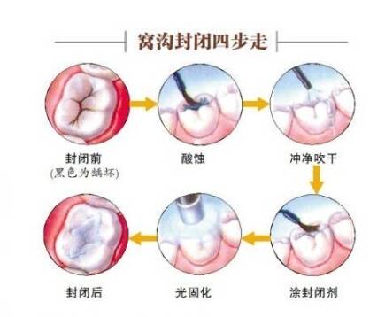 孩子少吃糖能预防龋齿吗？