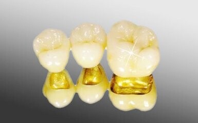 黄金烤瓷牙的寿命有多长？