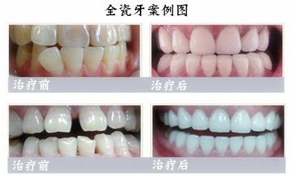 烤瓷牙矫正牙齿的优势有哪些？