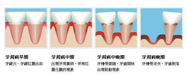 牙周病到底是如何形成的？