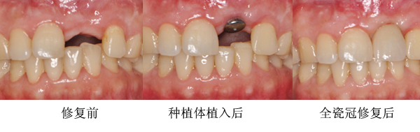 前牙种植适合哪些人？