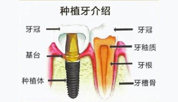种植牙牙冠松动怎么办？