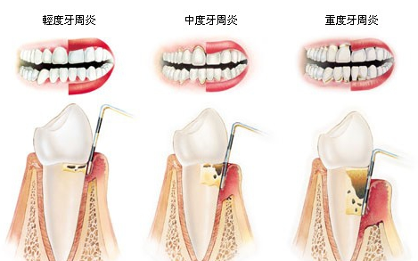 牙周炎治疗后会复发吗？