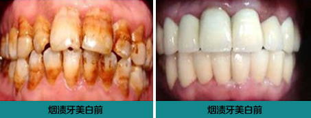 烟渍牙怎么变白？
