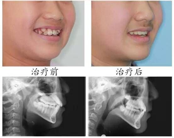 小孩做牙齿矫正大概多少钱？