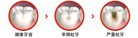 蛀牙反复发作怎么办？