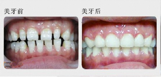 门牙有缝能做烤瓷牙修复吗？