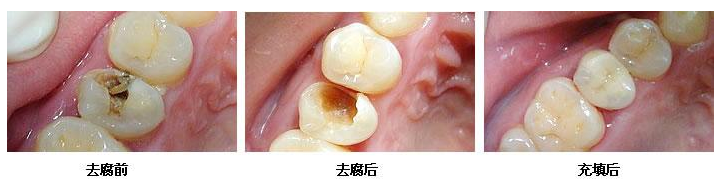 补牙对牙齿的伤害大吗？