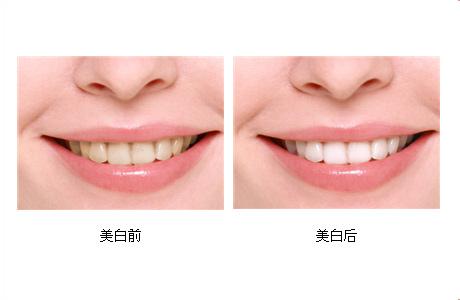 让牙齿变白都有哪些方法？