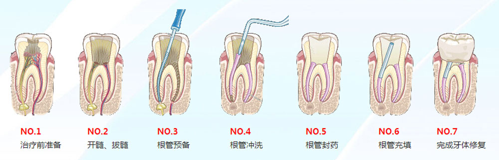 深圳做根管治疗一般多少钱？