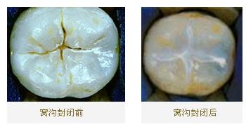 预防蛀牙做窝沟封闭真的有效吗？