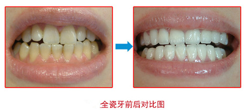 做全瓷牙后应该怎么进行保养？