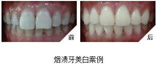 如何有效去除牙齿上的烟渍？