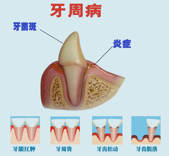 牙周病对人体有哪些危害？